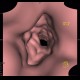 Crohn's  disease, cobble stone, virtual endoscopy: CT - Computed tomography